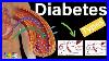 Diabetes-Mellitus-Type-1-Type-2-U0026-Other-Types-Of-Diabetes-01-evln